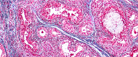 Recovery Time After Hemodialysis.