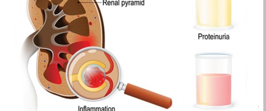 Understanding Infection-Related Glomerulonephritis