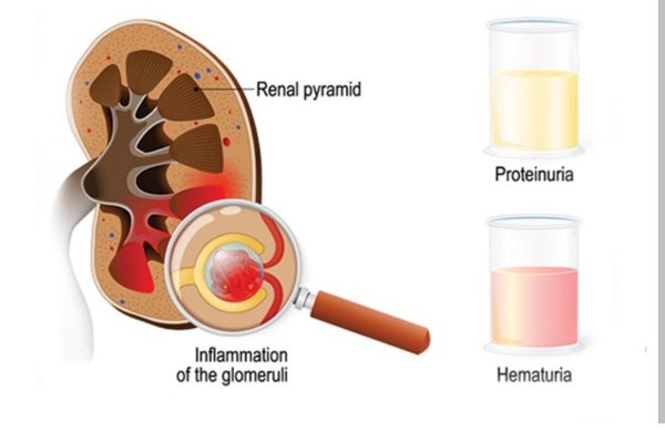 Understanding Infection-Related Glomerulonephritis