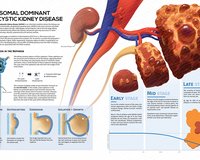 Understanding Severe Kidney Disease in Pediatric Autosomal